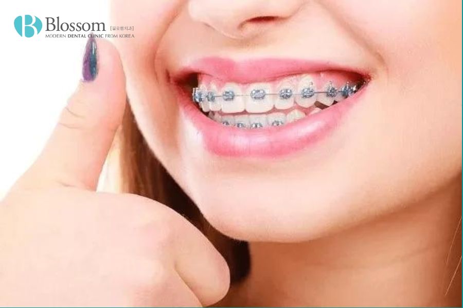 Chỉnh nha là gì? Một số phương pháp chỉnh nha phổ biến 8 chinh nha la gi 7