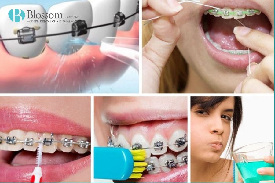 Chỉnh nha là gì? Một số phương pháp chỉnh nha phổ biến 9 chinh nha la gi 8
