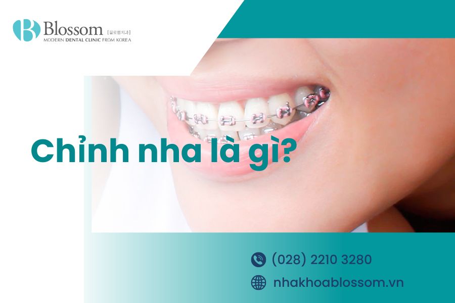 Chỉnh nha là gì? Một số phương pháp chỉnh nha phổ biến