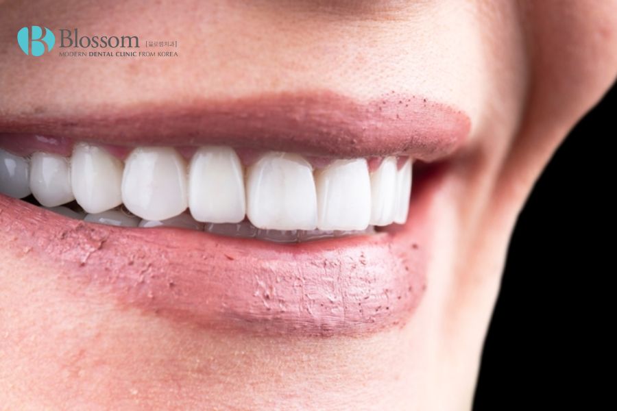 Có nên dán răng sứ Veneer không? Ưu nhược điểm dán sứ Veneer 3 co nen dan rang su veneer khong 2