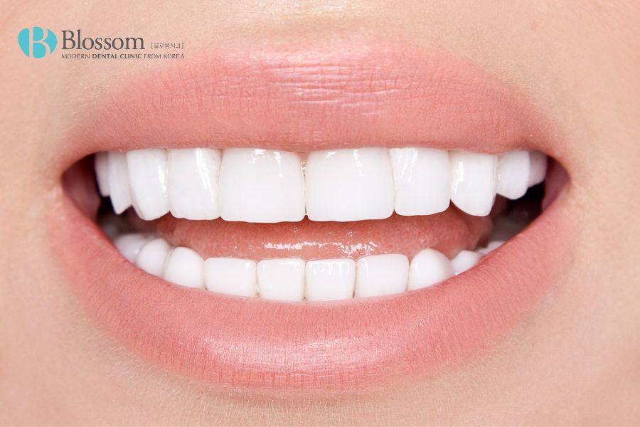 Có nên dán răng sứ Veneer không? Ưu nhược điểm dán sứ Veneer 4 co nen dan rang su veneer khong 3