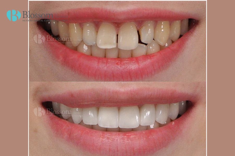 Có nên dán răng sứ Veneer không? Ưu nhược điểm dán sứ Veneer 8 co nen dan rang su veneer khong 7