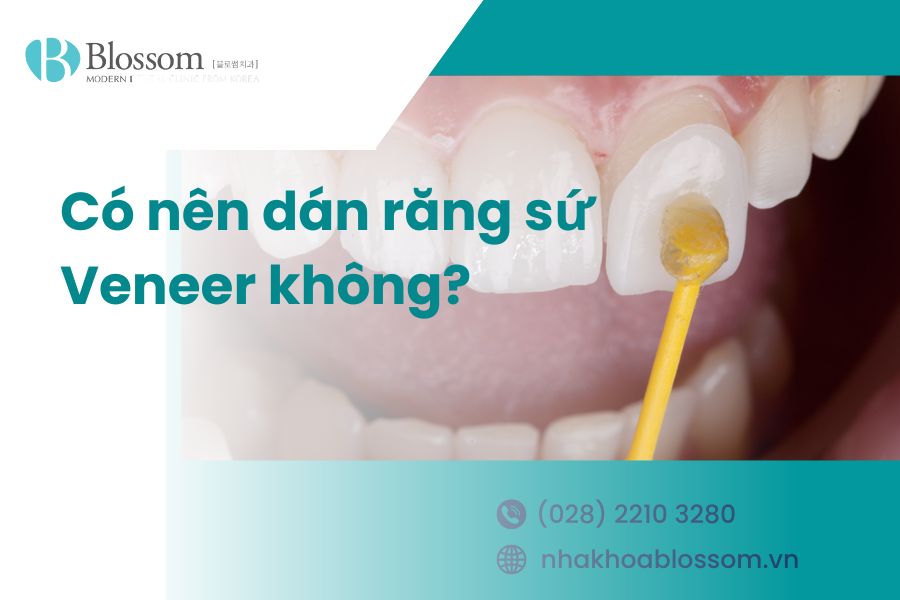Có nên dán răng sứ Veneer không? Ưu nhược điểm dán sứ Veneer