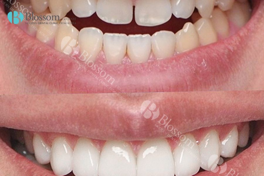 Phương pháp dán phủ sứ răng là gì? Giá bao nhiêu và có tốt không? 4 dan phu rang su 4