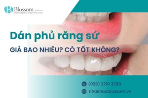 Phương pháp dán phủ sứ răng là gì? Giá bao nhiêu và có tốt không?