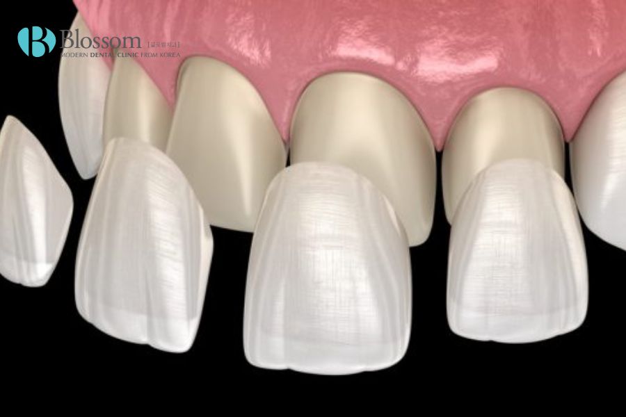 Dán răng sứ có đau không? Các đánh giá thực tế từ khách hàng 2 dan rang su co dau khong 1