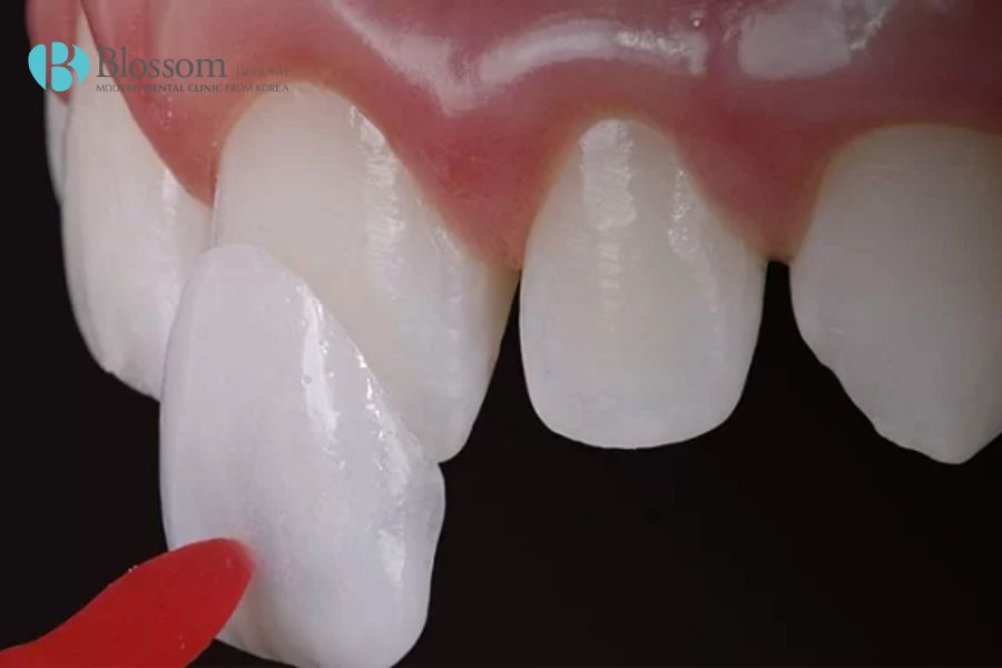 Dán răng sứ có đau không? Các đánh giá thực tế từ khách hàng 7 dan rang su co dau khong 6