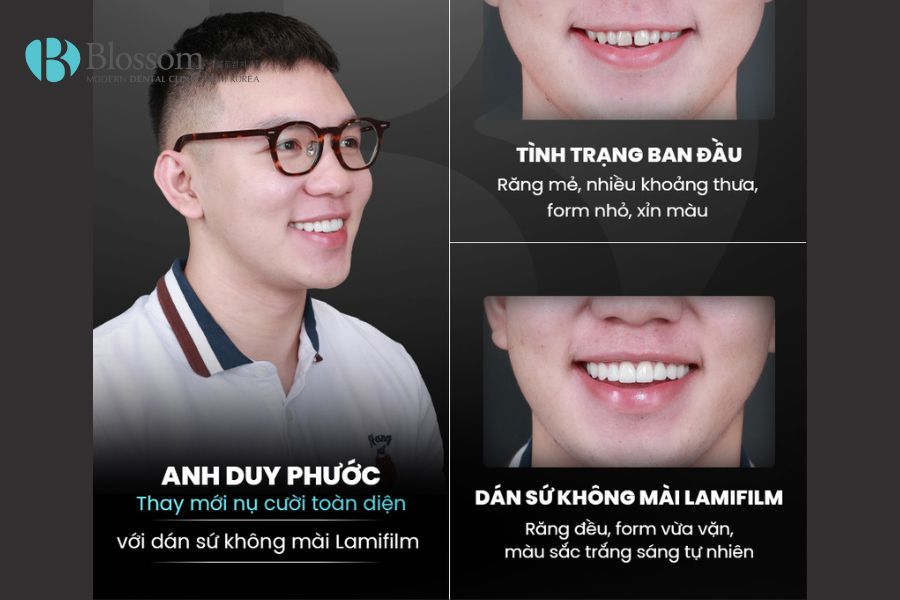 Dán răng sứ có đau không? Các đánh giá thực tế từ khách hàng 8 dan rang su co dau khong 7
