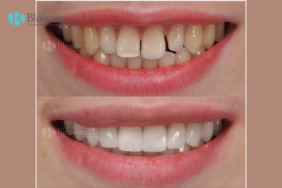 Dán răng sứ có đau không? Các đánh giá thực tế từ khách hàng 10 dan rang su co dau khong 9