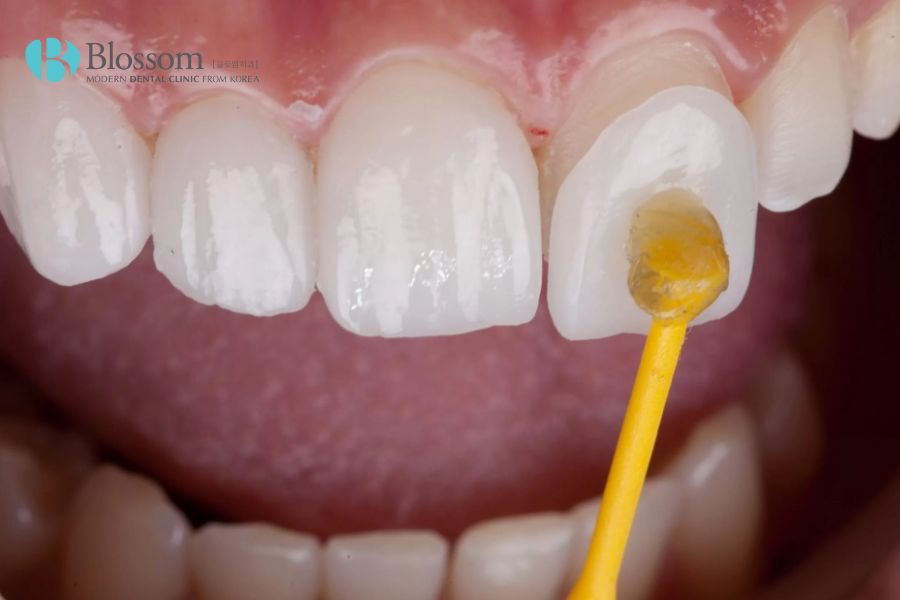 Dán răng sứ được bao lâu? Cách tăng tuổi thọ cho răng sứ 2 dan rang su duoc bao lau 1