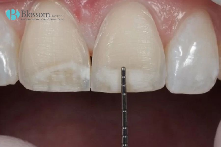 Dán răng sứ được bao lâu? Cách tăng tuổi thọ cho răng sứ 3 dan rang su duoc bao lau 2