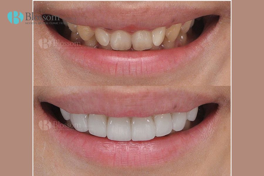 Dán răng sứ được bao lâu? Cách tăng tuổi thọ cho răng sứ 9 dan rang su duoc bao lau 8