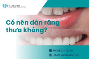 Có nên dán răng thưa không? Giá bao nhiêu? – Nha Khoa Blossom
