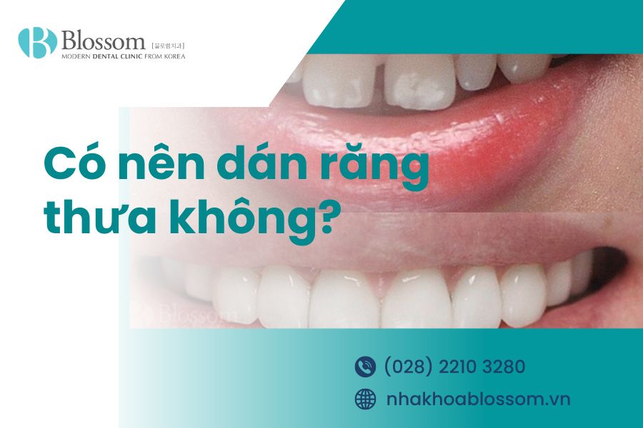 Có nên dán răng thưa không? Giá bao nhiêu? – Nha Khoa Blossom