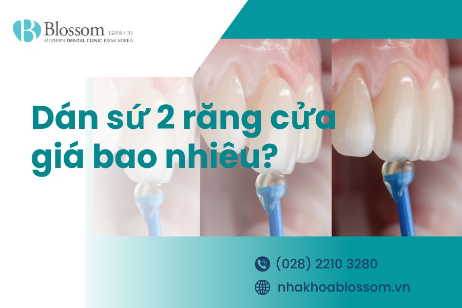 Dán sứ 2 răng cửa giá bao nhiêu và có tốt không?