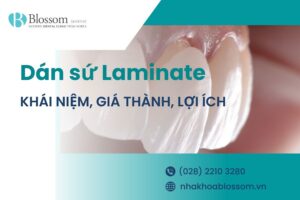Dán sứ Laminate là gì? Giá thành và những lợi ích bạn cần biết