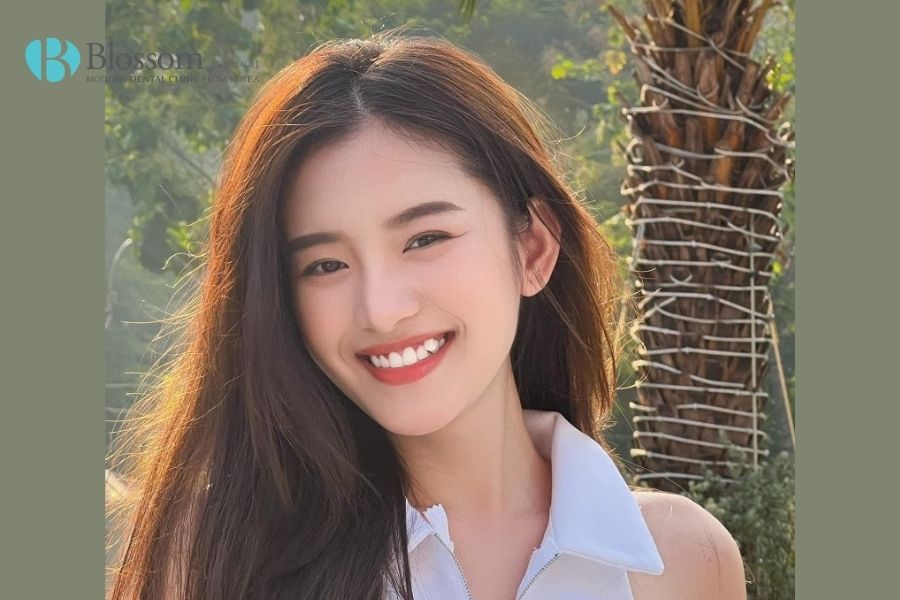 Dán sứ răng khểnh có được hay không? - Nha Khoa Blossom 2 dan su rang khenh 1