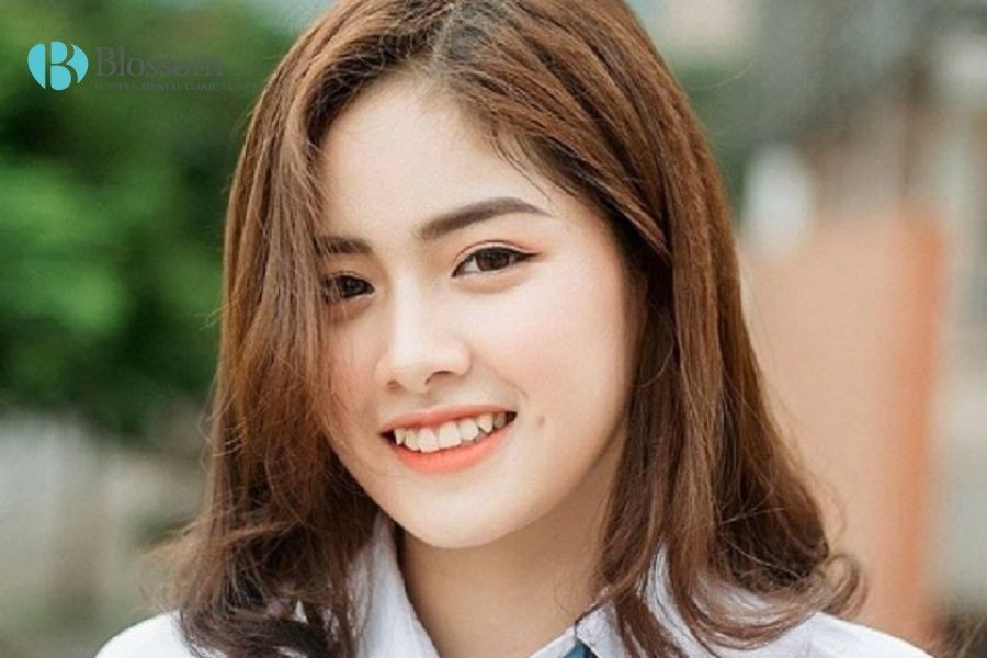 Dán sứ răng khểnh có được hay không? - Nha Khoa Blossom 4 dan su rang khenh 3