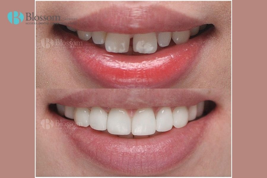 Dán sứ răng khểnh có được hay không? - Nha Khoa Blossom 6 dan su rang khenh 5