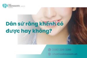 Dán sứ răng khểnh có được hay không? – Nha Khoa Blossom