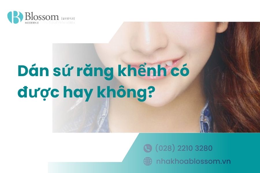 Dán sứ răng khểnh có được hay không? – Nha Khoa Blossom