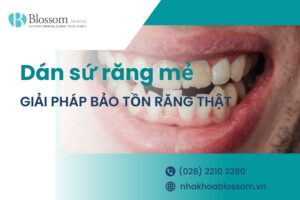 Dán sứ răng mẻ: Giải pháp bảo tồn răng thật hiệu quả hiện nay
