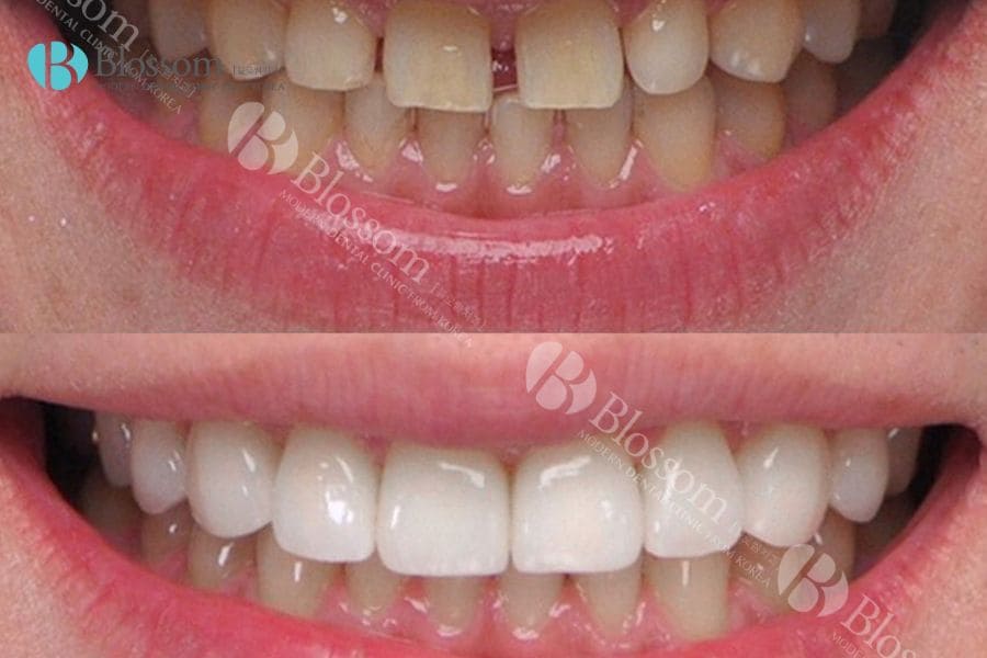 Dán sứ thẩm mỹ là gì? Những thông tin cần biết 11 dan su tham my 10