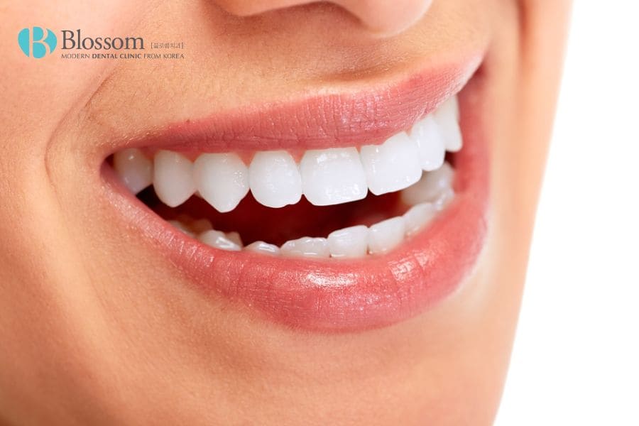Dán sứ thẩm mỹ là gì? Những thông tin cần biết 3 dan su tham my 2