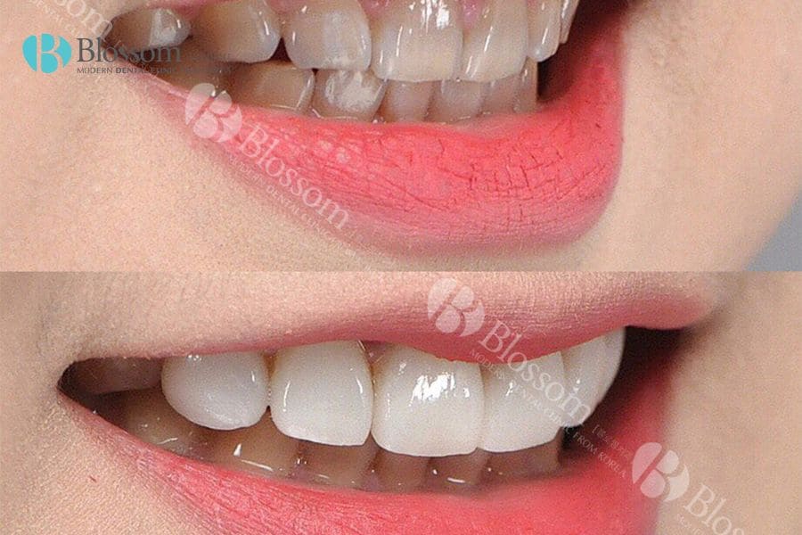 Dán sứ thẩm mỹ là gì? Những thông tin cần biết 5 dan su tham my 4