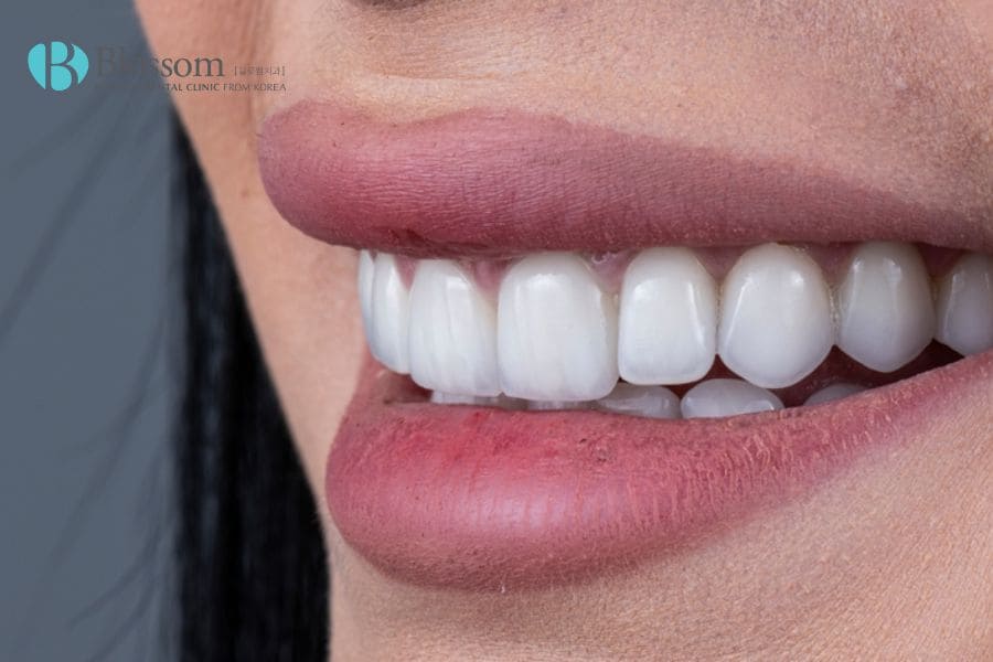 Dán sứ thẩm mỹ là gì? Những thông tin cần biết 8 dan su tham my 7