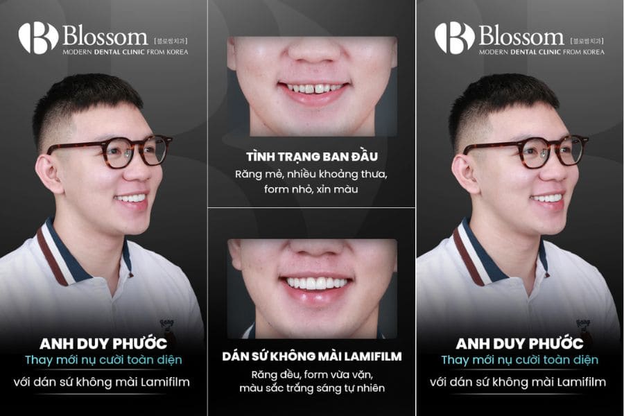 Dán sứ thẩm mỹ là gì? Những thông tin cần biết 10 dan su tham my 8