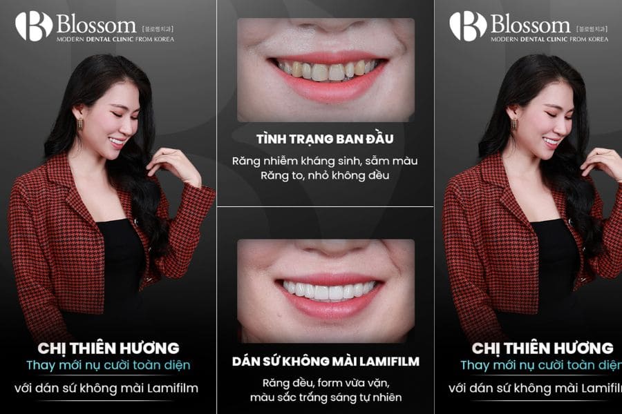 Dán sứ thẩm mỹ là gì? Những thông tin cần biết 9 dan su tham my 9