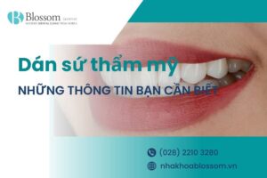 Dán sứ thẩm mỹ là gì? Những thông tin cần biết