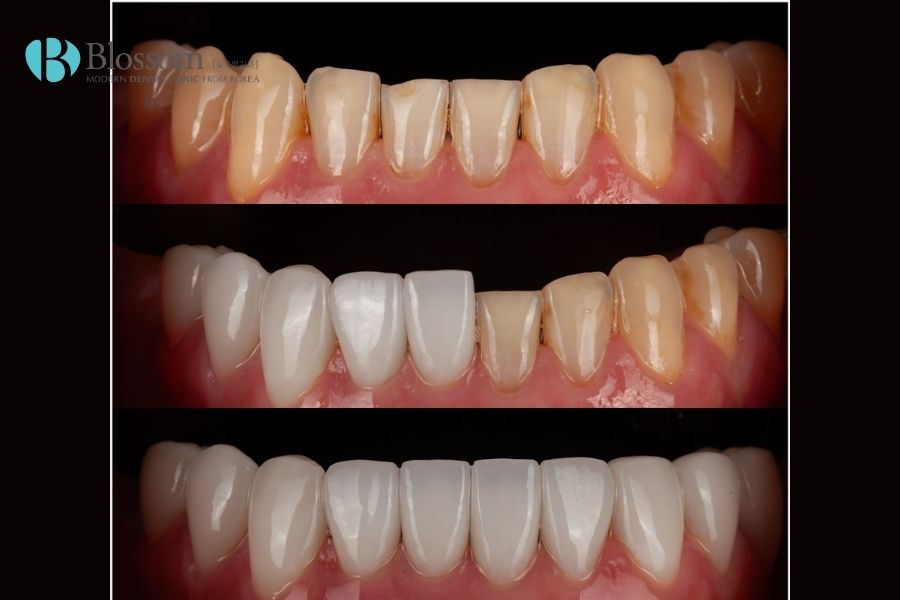 dan su veneer emax 10