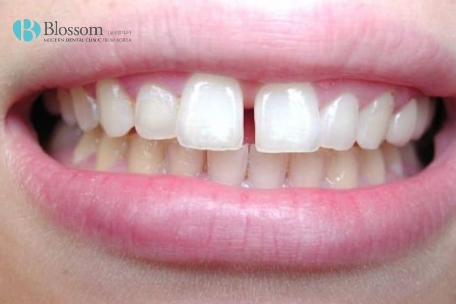 dan su veneer emax 2