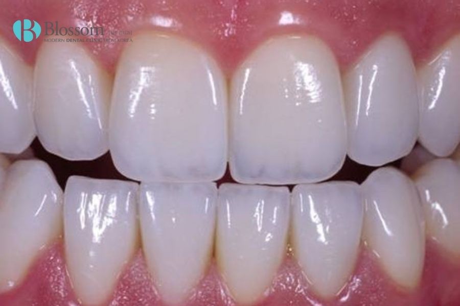 dan su veneer emax 3