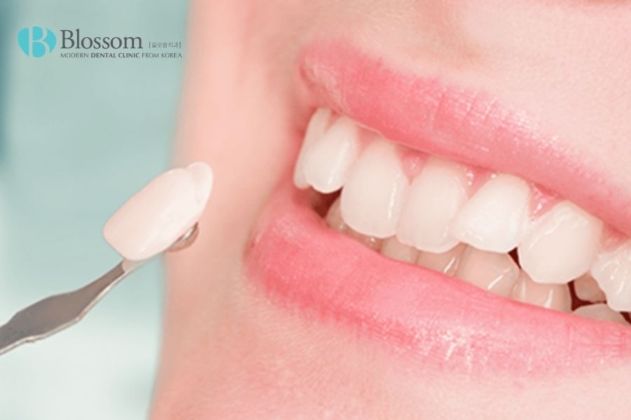 dan su veneer emax 4