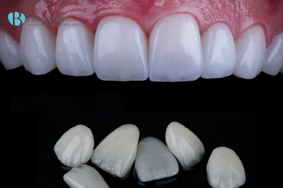 dan su veneer emax 5