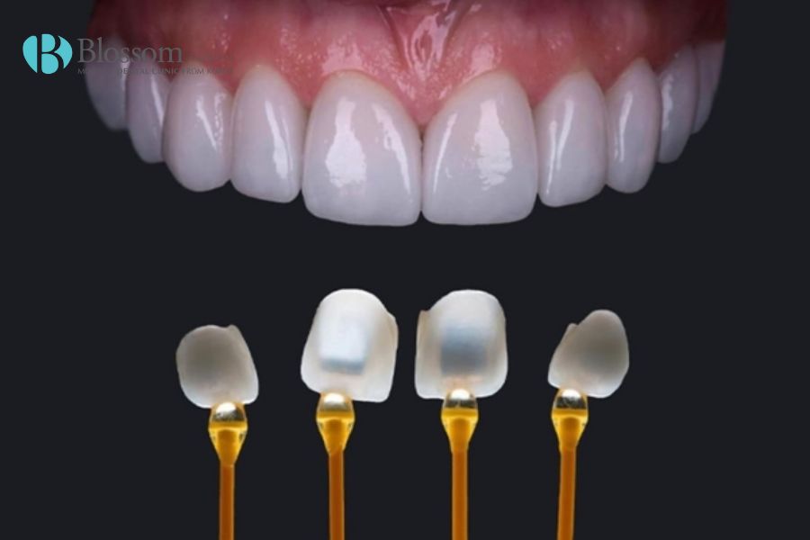 dan su veneer emax 7