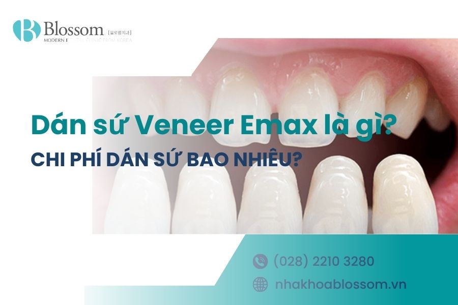 Dán sứ Veneer Emax là gì? Chi phí dán sứ bao nhiêu?