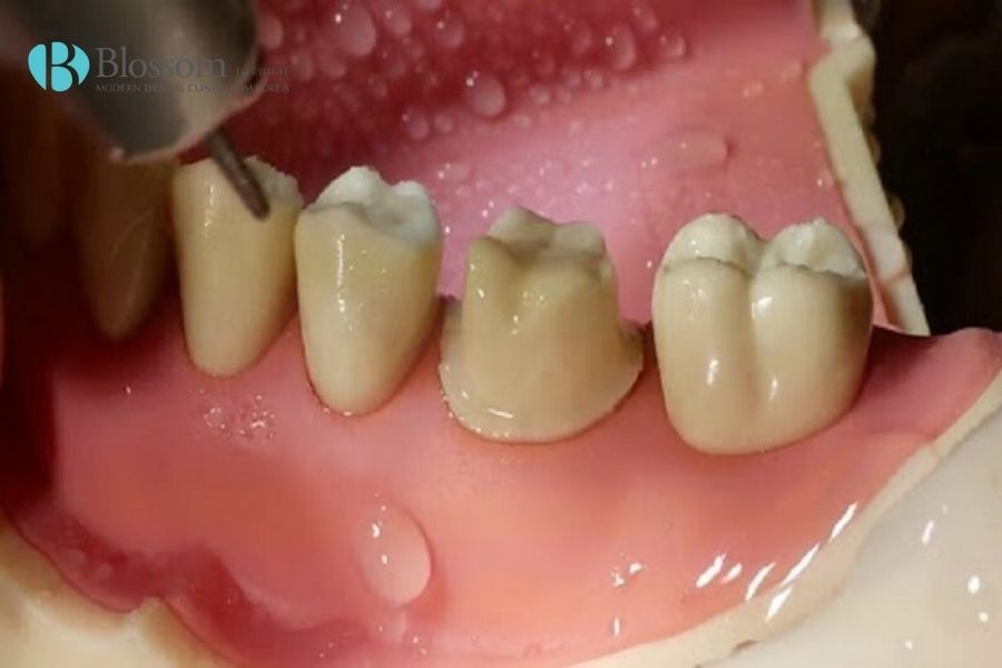 Đắp răng sứ là gì? Có đau không? Có chảy máu không? 4 dap rang su la gi 3