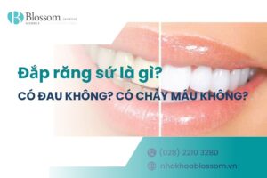 Đắp răng sứ là gì? Có đau không? Có chảy máu không?