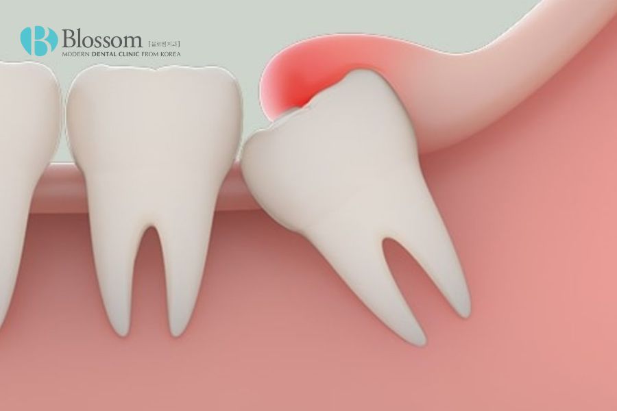 Đau răng khôn nên làm gì? Biện pháp điều trị răng khôn hiệu quả 2 dau rang khon nen lam gi 1