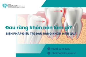Đau răng khôn nên làm gì? Biện pháp điều trị răng khôn hiệu quả