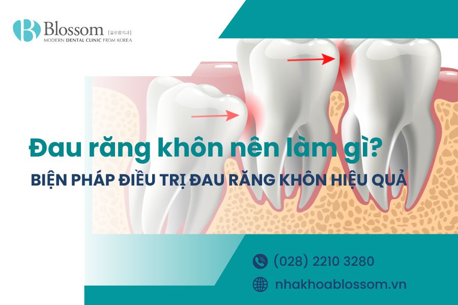Đau răng khôn nên làm gì? Biện pháp điều trị răng khôn hiệu quả 1 dau rang khon nen lam gi
