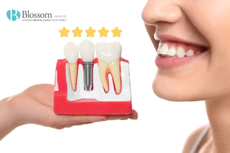 Top 11 địa chỉ làm răng Implant uy tín, bác sĩ tay nghề cao 14 dia chi lam rang implant uy tin 13