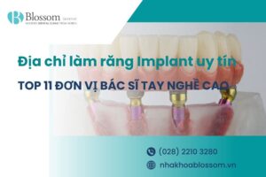 Top 11 địa chỉ làm răng Implant uy tín, bác sĩ tay nghề cao