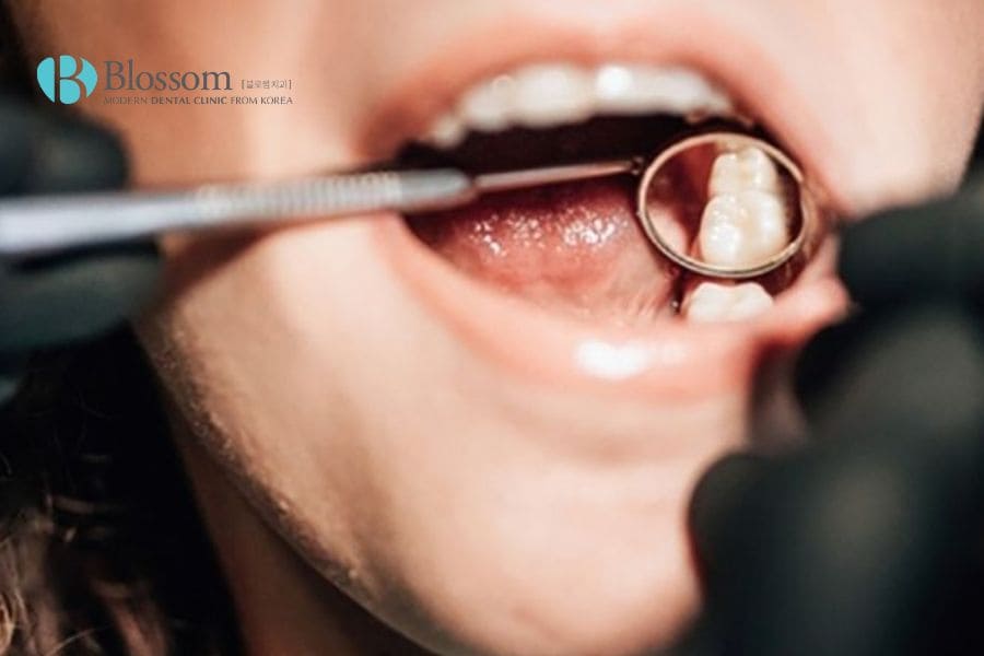 10 phương pháp điều trị nhức răng hiệu quả từ nha sĩ chuyên khoa 13 dieu tri nhuc rang 12