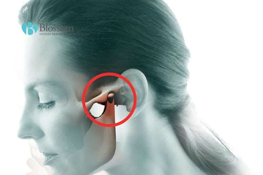 Há miệng có tiếng kêu khớp có nguy hiểm không? Điều trị thế nào hiệu quả? 3 ha mieng co tieng khop keu 2