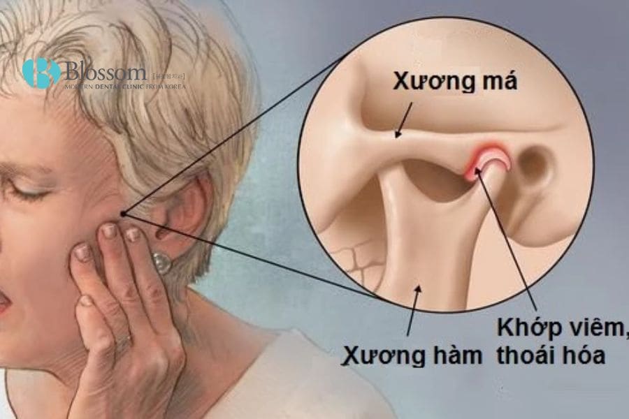 Há miệng có tiếng kêu khớp có nguy hiểm không? Điều trị thế nào hiệu quả? 4 ha mieng co tieng khop keu 3